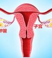 输卵管阻塞可以做试管婴儿吗？