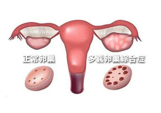 多囊卵巢做第三代试管婴儿的成功率高吗？