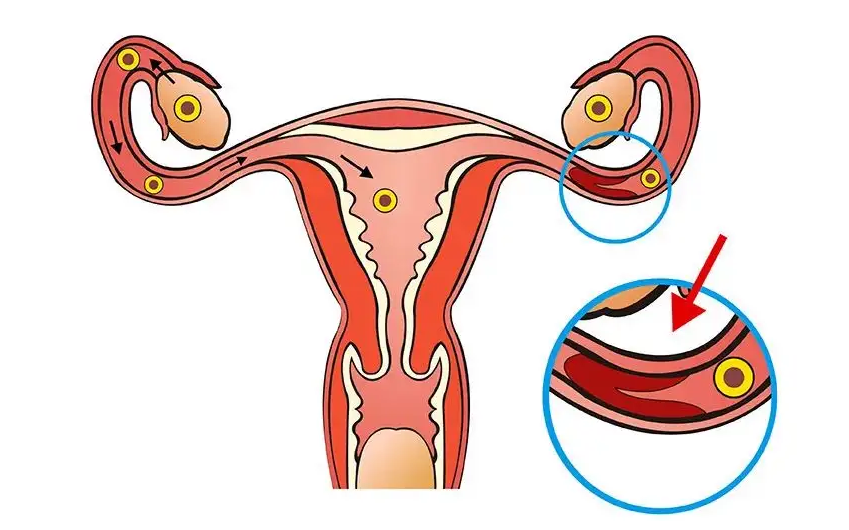 输卵管堵塞有什么办法可以怀孕