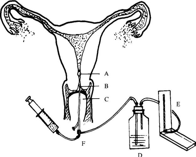 重庆做输卵管造影要多少钱一次,重庆做输卵管造影术吗