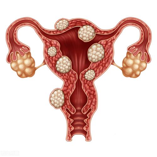 孕妇宫颈管可以检查息肉吗，孕妇宫颈管是否可检测息肉病变