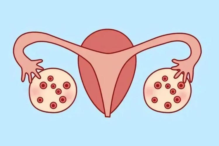 多囊卵巢能够治愈吗？